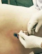 Skin Cancer Surgery