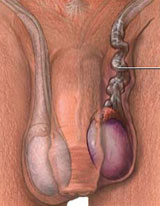 Testicular Cancer Surgery Testicular Cancer Surgery