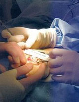 Therapy after Cancer Surgery Therapy after Cancer Surgery